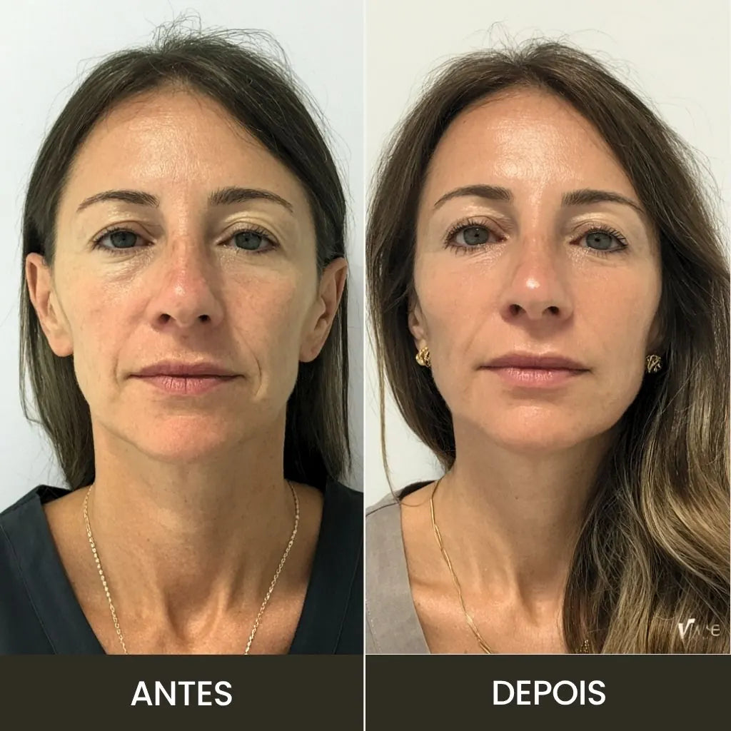 o aparelho Age-R booster trata e renova a pele
