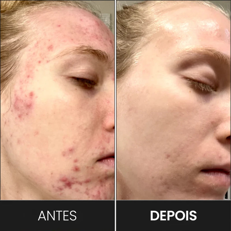 Máscara Vital Skin em uso 4