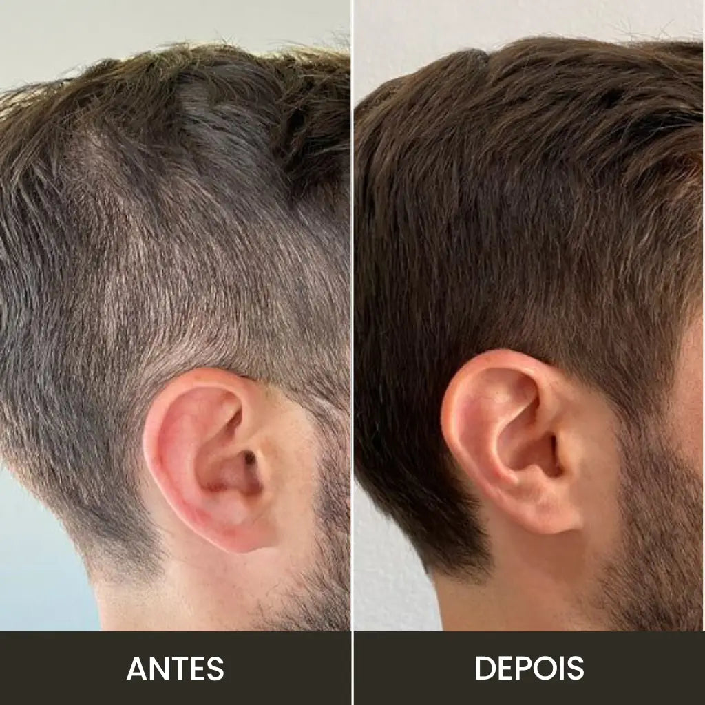 Imagem mostra a eficacia do toppik em esconder falhas capilares de forma natural