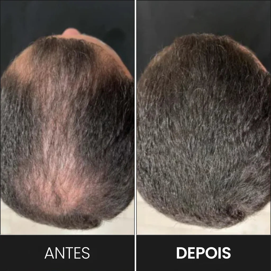 Foto mostra o "antes" e "depois" de um cliente que aplicou o Toppik com o borrifador para esconder sua falha capilar