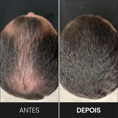 Foto mostra o "antes" e "depois" de um cliente que aplicou o Toppik com o borrifador para esconder sua falha capilar