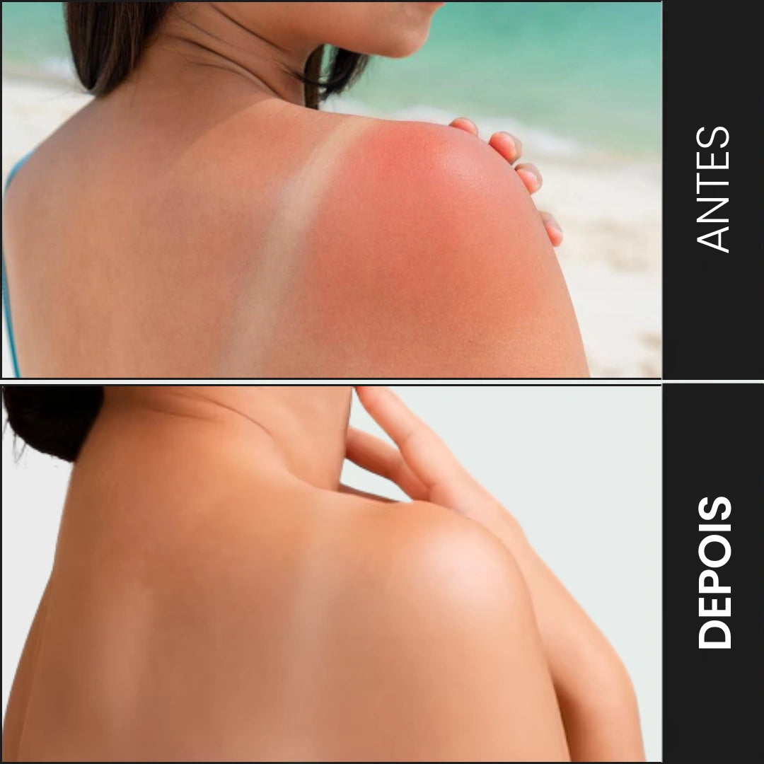 O gel de babosa diminui a inflamação e acalma a pele queimada pelo sol