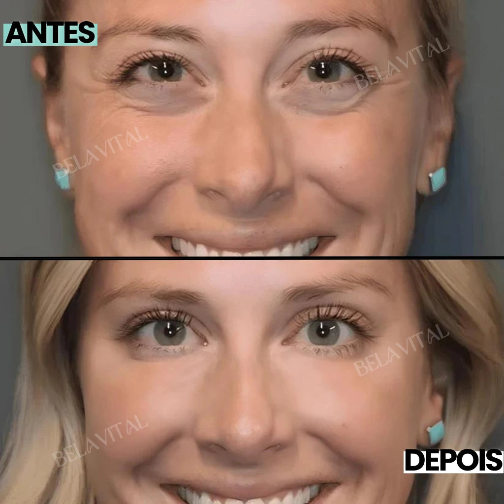 Transformação visível com Celyn: cliente antes e depois de usar o creme para olheiras na Loja Bela Vital.