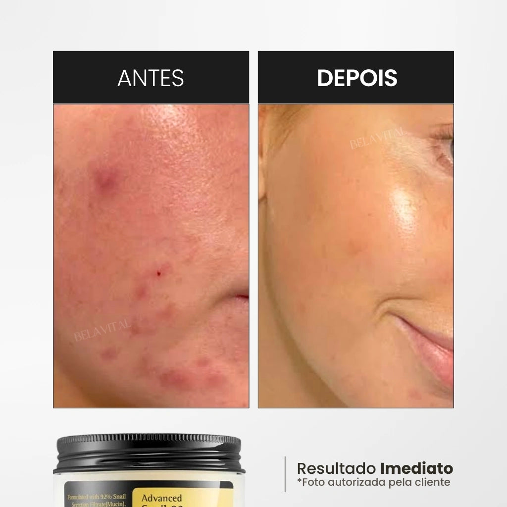 O Creme Coreano de baba de caracol trata peles com acne ativa