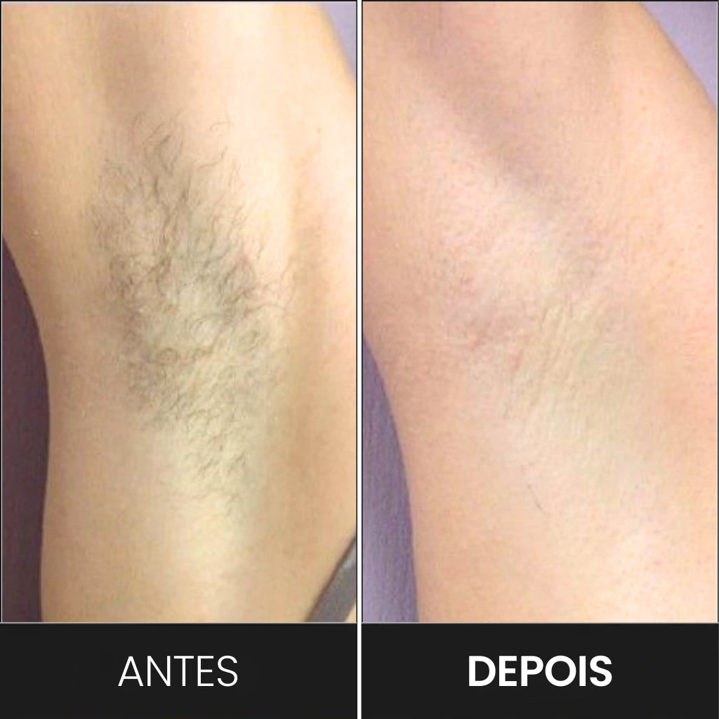 Foto mostrando a comparação da axilia "antes" e "depois" das sessões de depilação feitas com o aparelho IPL