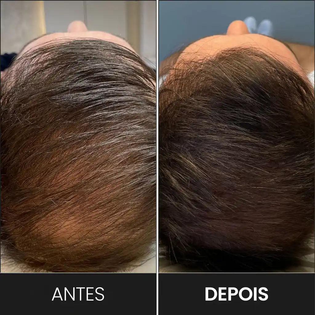 Uso do eletrodo pente no aparelho de alta frequência aumenta o crescimento capilar