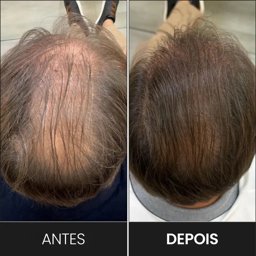 Antes e depois comprovando que o FEG aumenta o crescimento capilar