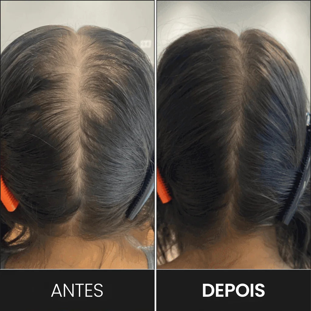 Mulher que usou o FEG e aumentou a quantidade de fios de cabelo