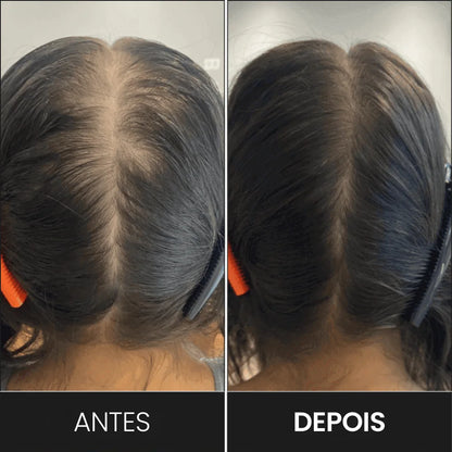 Mulher que usou o FEG e aumentou a quantidade de fios de cabelo