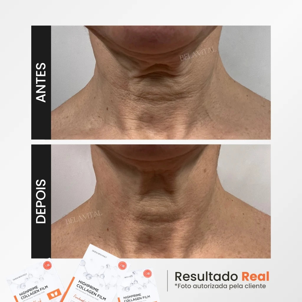 Imagem mostrando o "Antes e Depois" do tratamento da região do pescoço com a máscara de Colágeno GoldBotox Highprime