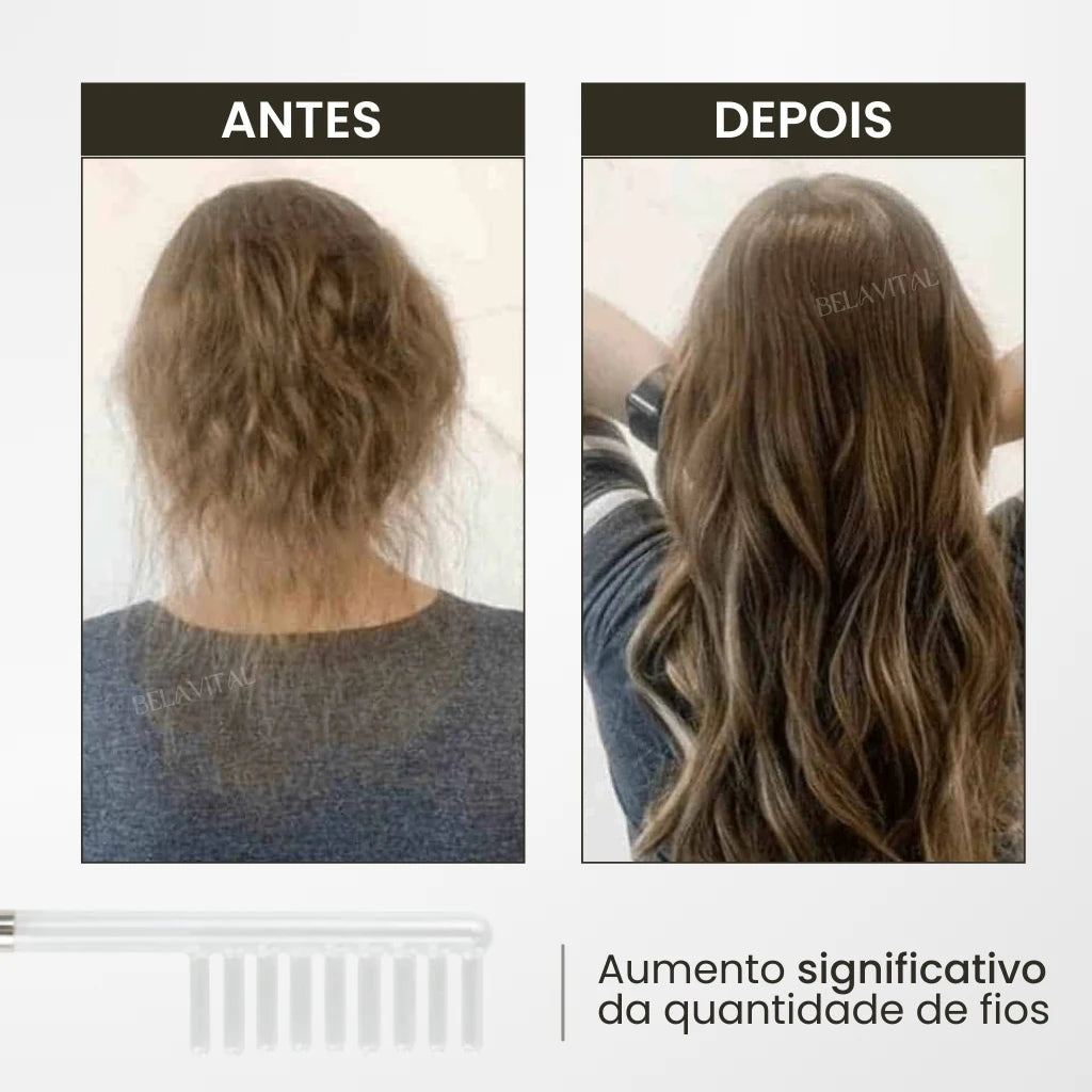 Imagem mostra os resultados do uso do Kit Derma Capilar que aumentou significativamente a quantidade de fios de cabelo após o tratamento