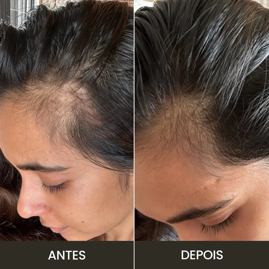 Resultados no crescimento capilar com o uso do massageador elétrico