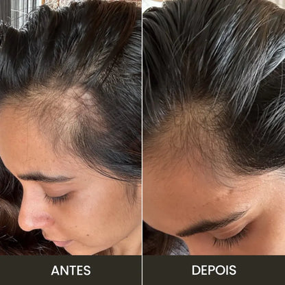 Resultados no crescimento capilar com o uso do massageador elétrico