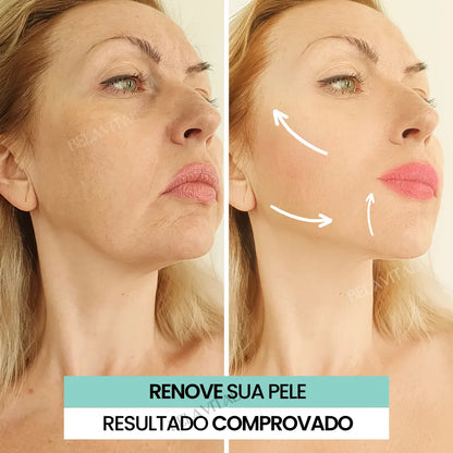 Mi Acid+ Tratamento Facial Premium Completo