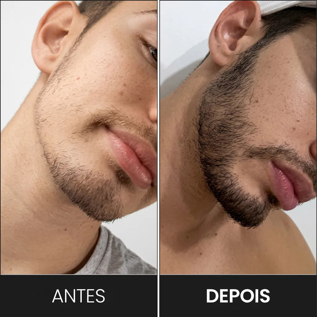 Resultado do tratamento de alha na barba, usando apenas dermaroller