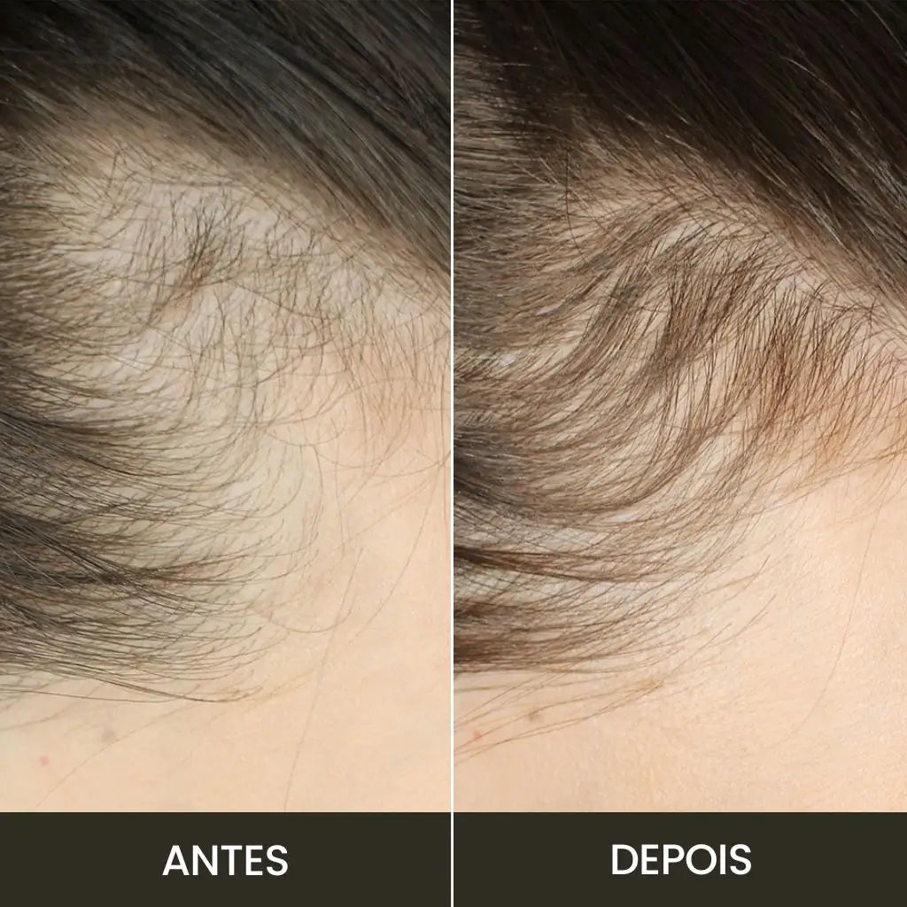 Imagem mostrando como a Escova Laser Antiqueda Therabrush aumentou a quantidade de fios de cabelo