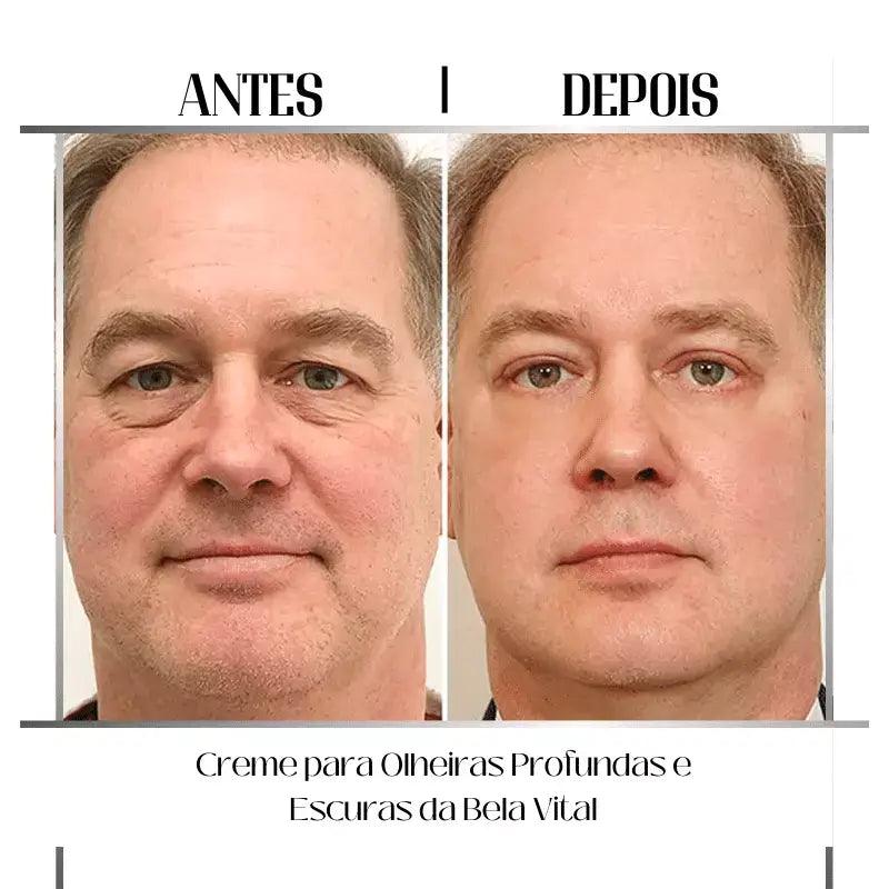 Efeitos do Creme para Olheiras Profundas e Escuras da Bela Vital