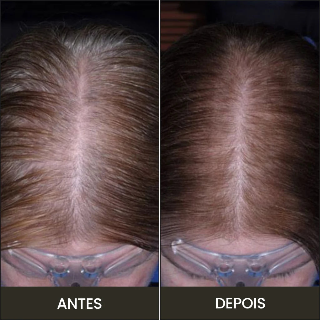 Resultado do tratamento com a escova massageadora para crescimento capilar
